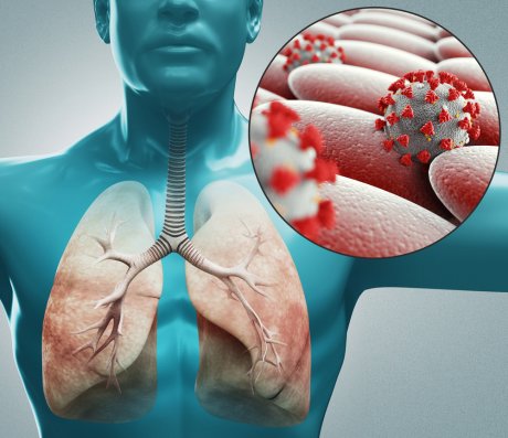 uplala pluća izazvana koronavirusom