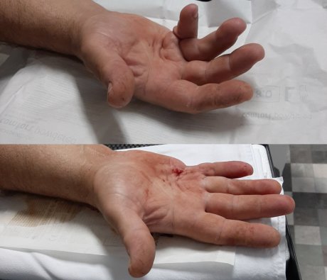 dipitrenova bolest kontraktura