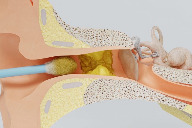 Nepravilno čišćenje ušiju