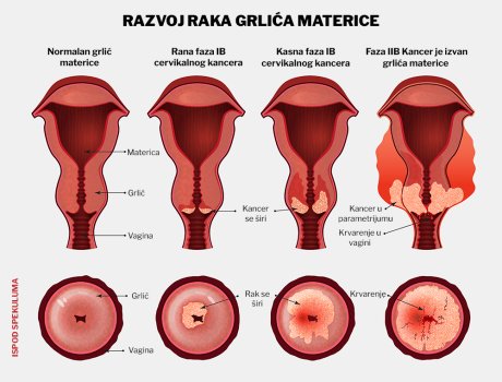 rak grlića materice