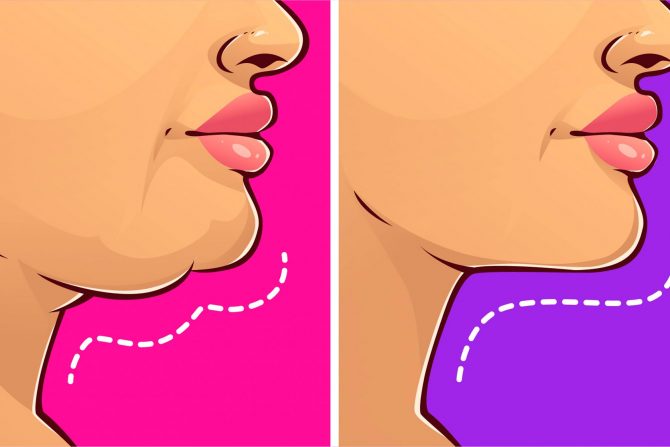 vežbe za uklanjanje podbratka