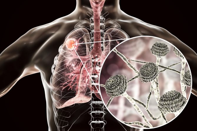 pluća gljivice mikroorganizmi infekcije