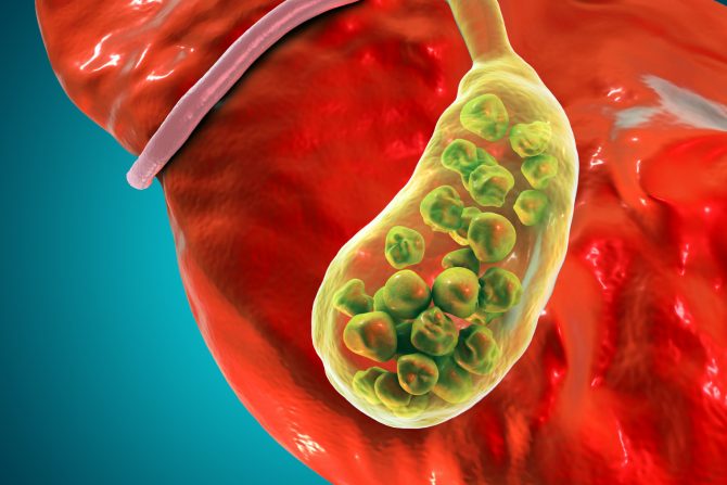 kamen u žučnoj kesi