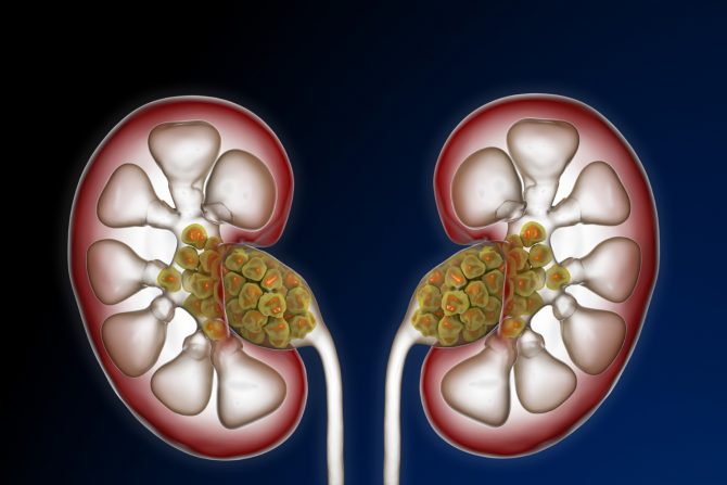 kamen u bubregu trudnoća porođaj