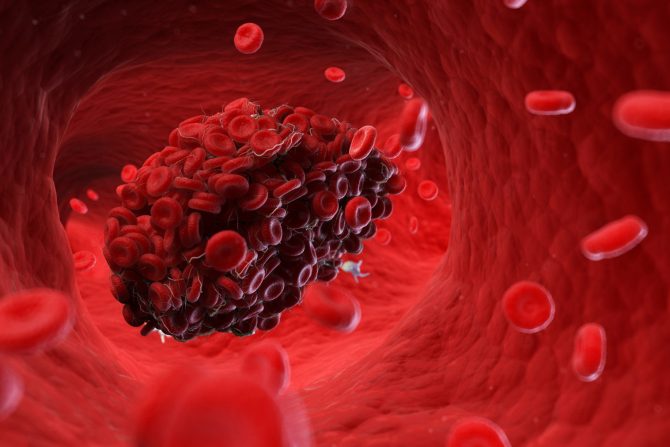 krvni ugrušci moždani udar estrogen