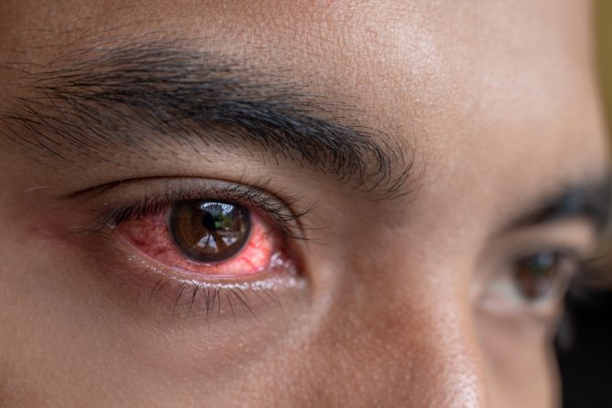 crveno oko-bolest-povreda