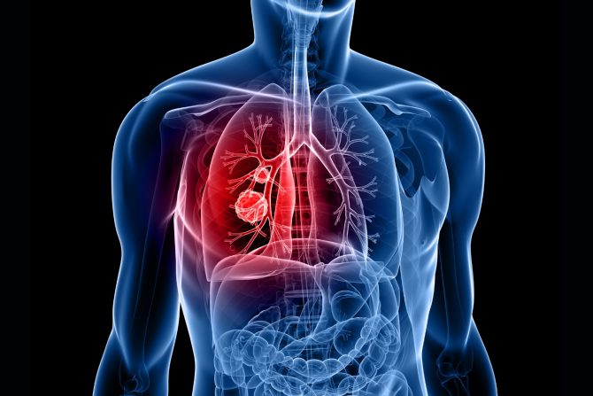 rak pluća- karcinom- plućna krila