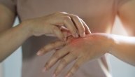 Novi lek za psorijazu mnogo je efektniji od već postojećih, rezultati su novog kliničkog ispitivanja