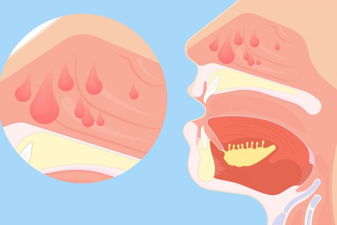 postanazal-grlo-sluz-nos