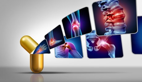 Fibromijalgija, bol, dijagnostika, terapija