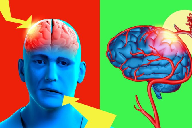 srčani udar- gojaznost- srce