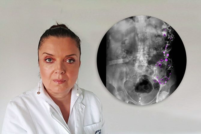 Dr Tatjana Radaljac, kolon, divertikulum, divertikuloza