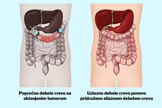 kolektomija-debelo crevo-tumor debelog creva