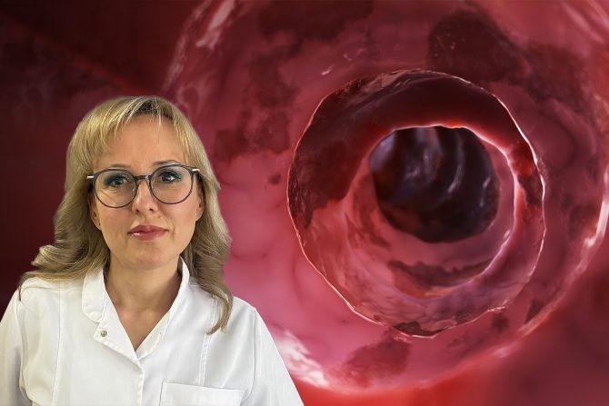 Prof.dr Tamara Milovanović, ulcerozni kolitis