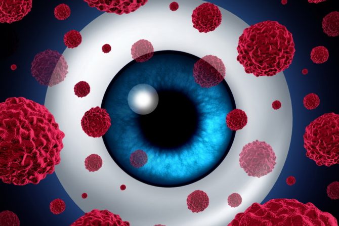 očni kancer- inakularni melanom -oči