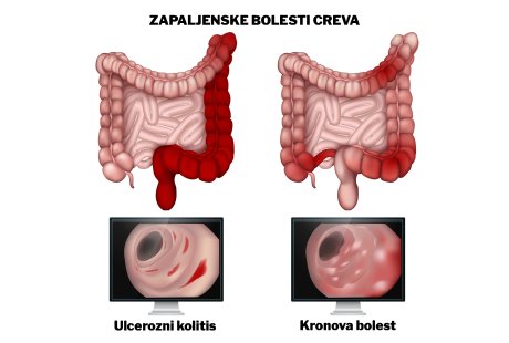 Zapaljenske bolesti creva, ulcerozni kolitis, Kronova bolest
