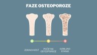 Osteoporoza može da se odloži ako redovno preduzimate ovih 6 koraka