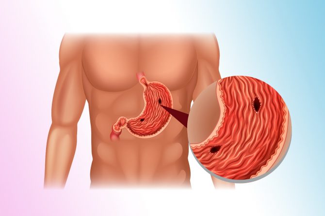 čir na žucu-stres-kiselina