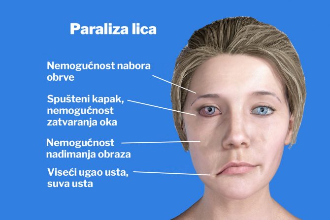 paraliza lica-pareza-facijalis