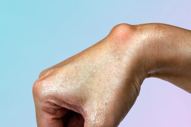 Epidermoidne ciste- lojne ciste-sebum