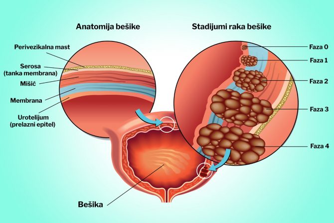 bešika-rak-rak bešike