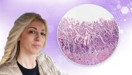 Autoimuni atrofični gastritis oštećuje želudac, a dr Ana Kalaba ističe i da dovodi do anemije