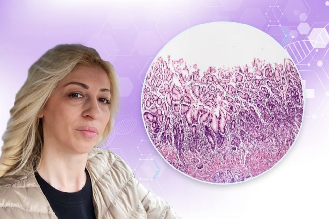 Dr Ana Kalaba-Dijagnoza- autoimuni atrofični gastritis