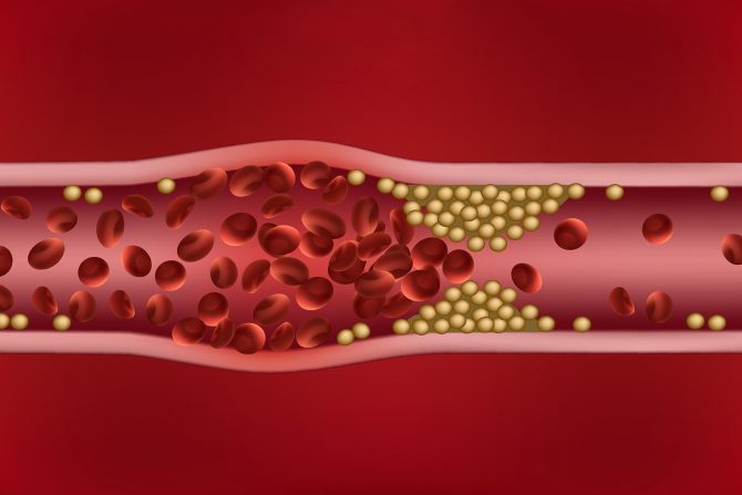 masna embolija-prelom kosti-krv