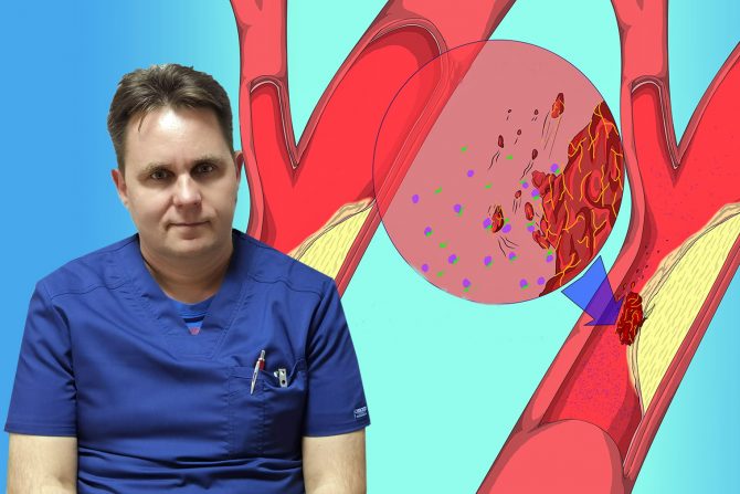 mehanička tombektomija-moždani udar- dr ivan vukašinović