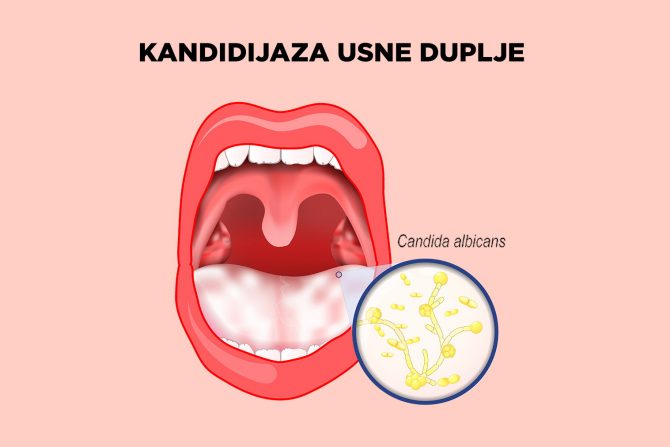 kandida- usna duplja- gljivična infekcija