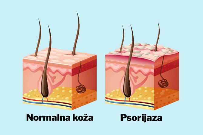 psorijaza- bolest kože- kardivaskularni problemi
