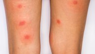 Reumatoidni artritis može da bude uzrok burnih reakcija, ali i infekcija nakon ujeda insekata