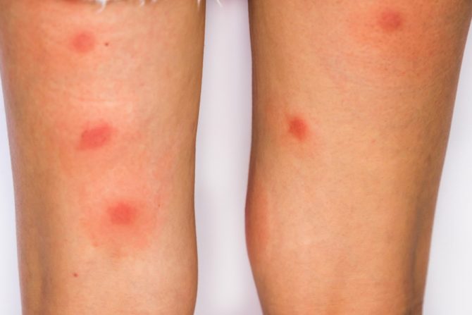 ujedn insekta-infekcija-zarazna bolest