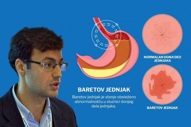 barretov jednjak- oštećena sluznica- kiseli želudačni sadržaj-karcinom