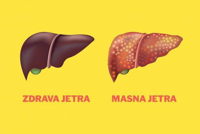 jetra-masna jetra-poremećaj metabolizma masti