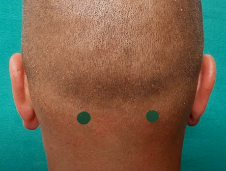 Feng Chi tačke, akupresura