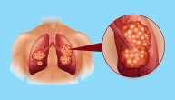Mikrocelularni karcinom pluća je agresivan rak koji ne pokazuje nikakve simptome, sve dok ne bude kasno
