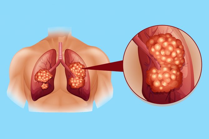 rak pluća- agresivan karcinom pluća- mikrocelularni rak