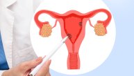 Polipe na materici važno je što pre otkriti jer lako mogu da prerastu u tumor