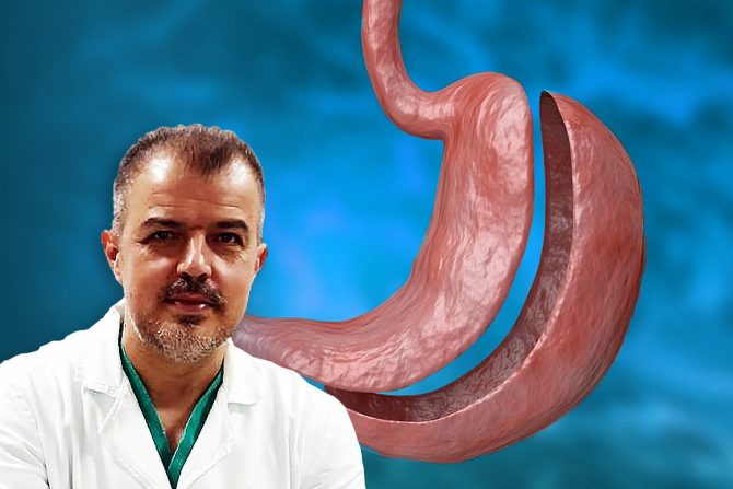 smanjenje želuca-gojaznost-viscelarna mast