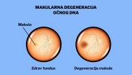 Makularna degeneracija pogađa centralni deo mrežnjače i razlog je što sve vidimo mutno, iskrivljeno, tamno…