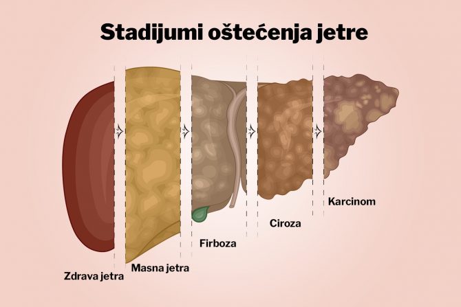 jetra-hronićne bolesti-rizik-masna jetra