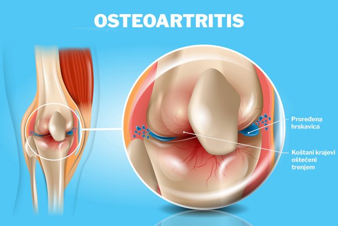 osteoartritis - zglob-hrskavica-ograničeni pokreti