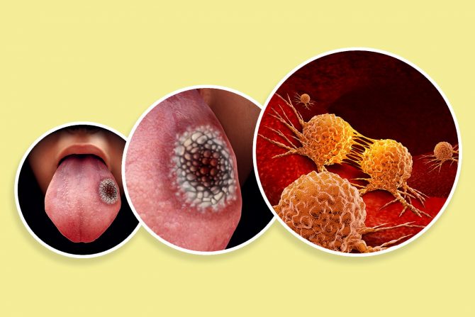 zdravlje usta- dijabetes- karcinom usta-karcinom grla