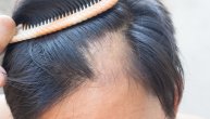 Alopecija je opadanje kose u pečatima. Lek još ne postoji, ali pomažu neki prirodni preparati