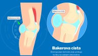 Bekerova cista može da napravi ozbiljan zdravstveni problem kada pukne