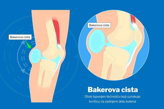 bakerova cista-cista na kolenu-pucanje ciste