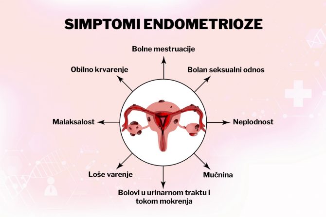 endometrioza- simptomi- lečenje