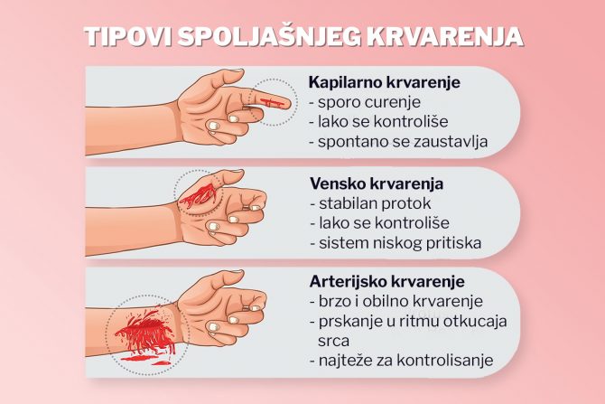 tipovi krvarenja -spoljnje krvarenje- arterijsko krvarenje