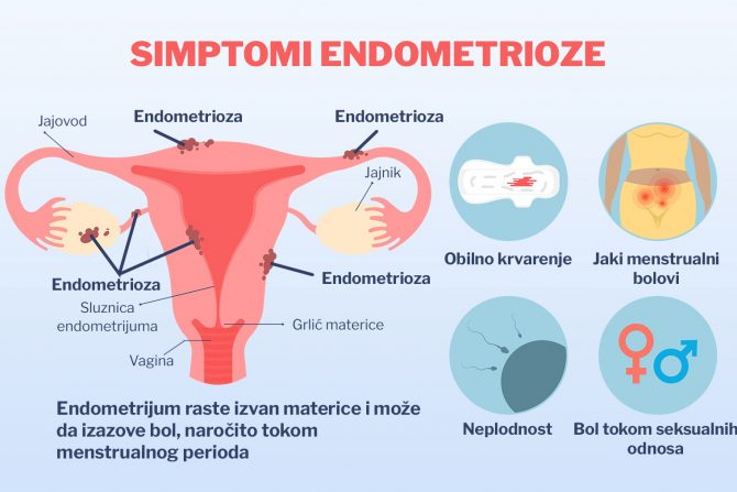 endometrioza. hormonski disbalans- bol u karlici- neplodnost
